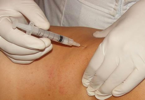 mesoterapia
