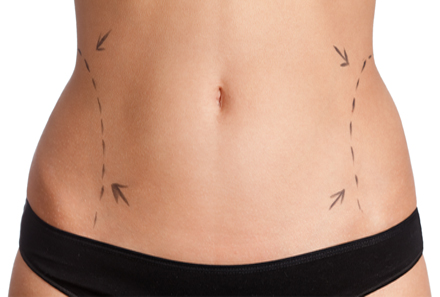 Liposucción, introlipoterapia