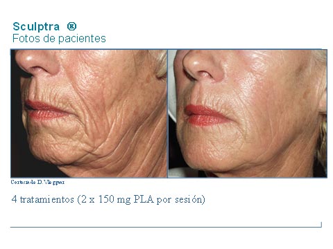 Rejuvenecimiento facial con Sculptra Foto paciente mujer, antes y después del tratamiento con Sculptra