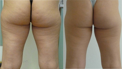 Ondas de choque combate la celulitis y alisa la piel antes-despues