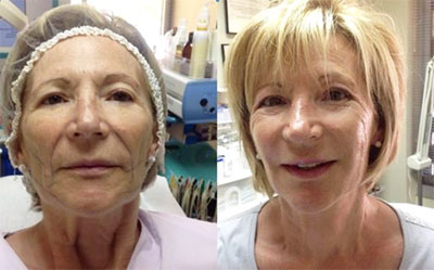 Rostro mujer antes y después del tratamiento de lifting facial