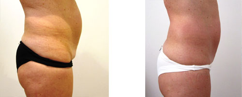 Medicina estética contra la grasa | Quality Clinic Mujer antes y después de tratamiento