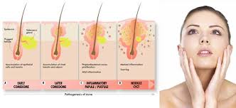 Evolución gráfico del acné