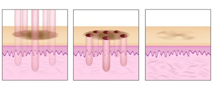 esquema tratamiento Banquamiento en la dermis