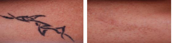 Antes y después de tratamiento de borrar tatuaje