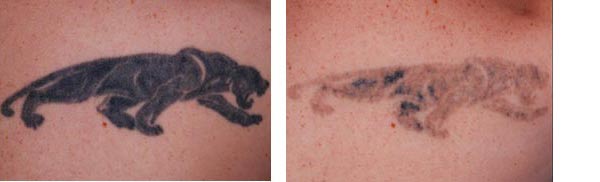 Eliminar Tatuajes | Quality Clinic