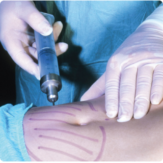 Liposucción con jeringa