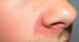 Dermatitis seborreica