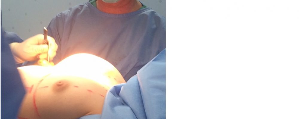 Cirugía mamaria con el Dr Granado Tiagoncé